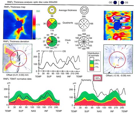 optical coherence tomography test results